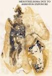 <b>Mesothelioma</b> is one of
