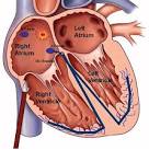 of a <b>catheter ablation</b>