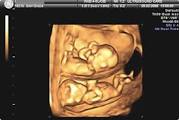 Image result for dating ultrasound accuracy
