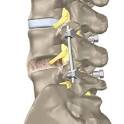 <b>spinal fusion</b>
