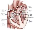 What is <b>heart valve disease</b>?