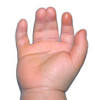 <b>Syndactyly</b> - definition and