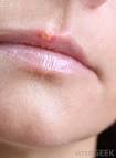 Types of <b>Lip Disease</b>?