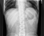 <b>Hepatomegaly</b> | Image | Radiopaedia.