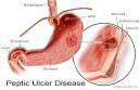 of <b>ulcer</b> formation.