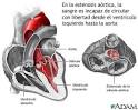 En la estenosis <b>aórtica</b>,