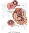 Interstitial, <b>Abdominal</b>, and Ovarian <b>Pregnancy</b> - Netter Medical Images