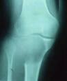 <b>Tumor</b> de <b>células gigantes</b>: