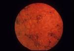 Fundus in <b>Usher syndrome</b>