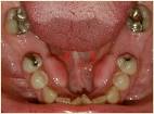 <b>Exostoses</b>, the growths