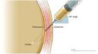 <b>Ascites</b> is an important
