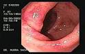 Collagenous Colitis.