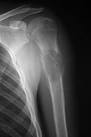 <b>Osteosarcoma</b> often starts near