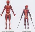 <b>Muscular</b> dystrophy is when