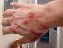 Morgellons disease is a