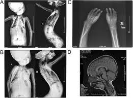Image result for Progeria other imaging findings