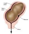 The good news is that <b>encopresis</b> can be treated.