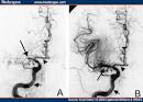 The <b>cerebral angiogram</b> of an
