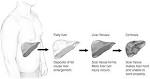 This leads to fatty <b>liver</b>,