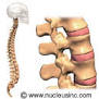 SPINAL STENOSIS of the Lower Back (Lumbar SPINAL STENOSIS) Overview