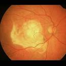 The EyePathologist - MACULAR DEGENERATION - © Duke University