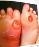 Il piede diabetico | Milocca - Milena Libera - piede-diabetico1