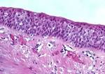 File:Bronchial squamous <b>metaplasia</b>.jpg - Wikimedia Commons