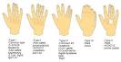 Hand <b>syndactyly</b>, <b>syndactyly</b>