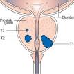 Prostate cancer - Wikipedia, the free encyclopedia