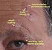 <b>Herpes zoster ophthalmicus</b>