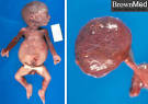 <b>prune belly syndrome</b> - meddic