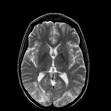 <b>Hypertensive Encephalopathy</b>: