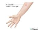 <b>Tuberculin</b> skin test: