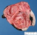 sacrococcygeal teratoma - Humpath.com - Human pathology
