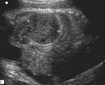 a <b>mesoblastic nephroma</b> was