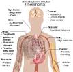 Community-acquired pneumonia - Wikipedia, the free encyclopedia
