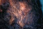 <b>Angiolymphoid hyperplasia</b> with <b>eosinophilia</b>: A study of 7 cases