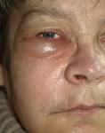File:<b>Abscess</b> cheek.jpg