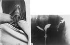Volume 1, Chapter 70. Surgical Correction of Uterovaginal Anomalies
