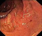 <b>Pouchitis</b>, an inflammation in