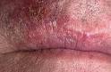 <b>Lip Diseases</b>
