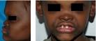 <b>Hypohidrotic ectodermal dysplasia</b>