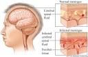 recorded <b>viral meningitis</b>.