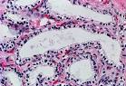 Pancreas - <b>Serous cystadenoma</b>