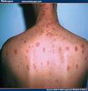 Immune Restoration Disease After Antiretroviral Therapy: Sarcoid ...