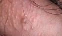 Pimple on Penis Solution to Clear Pimple on Penis | How to get rid ...