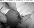The <b>male genital</b> infestation