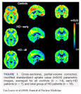 Neuroskeptic: Cannabinoids in Huntington's Disease