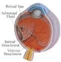 Shah Ramesh R - Joplin, MO- <b>Retinal Detachment</b>