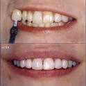 <b>Tooth Discoloration</b> - Are Symptoms and Treatment